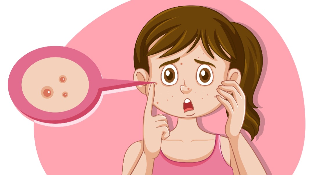 Cara Mengatasi Munculnya Jerawat Haid